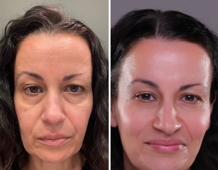 Before-and-after photos showing the results of a facelift on a middle-aged woman with dark hair and improved facial contours.