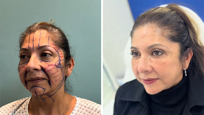 Before-and-after photos of a woman showing facelift markings and her rejuvenated appearance after surgery.