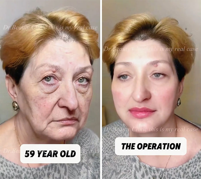 Before-and-after facelift photos showing dramatic facial rejuvenation on a 59-year-old woman post operation.
