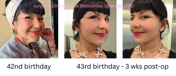 Before-and-after facelift photos showing a woman’s facial transformation three weeks post-operation at age 43.