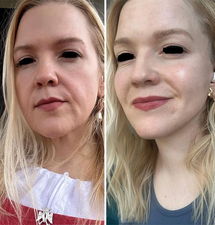 Before and after facelift photo of a woman showing smoother and more youthful facial skin and contours.