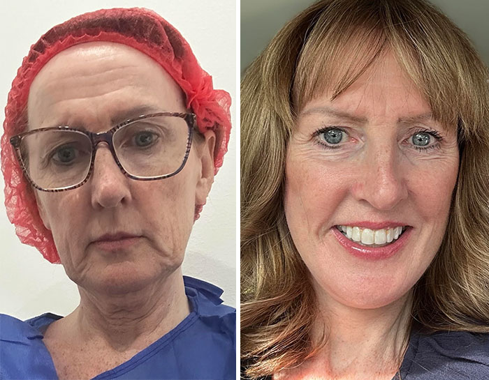 Before-and-after facelift photos show a woman’s refreshed and youthful facial transformation with smoother skin and a radiant smile.