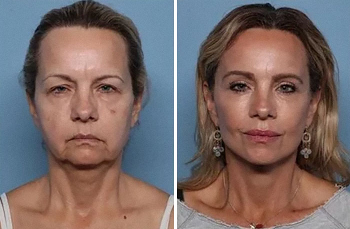 Before-and-after photos of a woman showcasing dramatic facelift results with smoother, youthful facial features and reduced wrinkles.