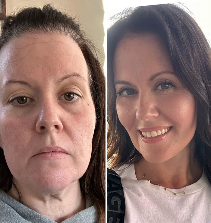 Before-and-after photos showing a woman's facial transformation and rejuvenation following a facelift procedure.