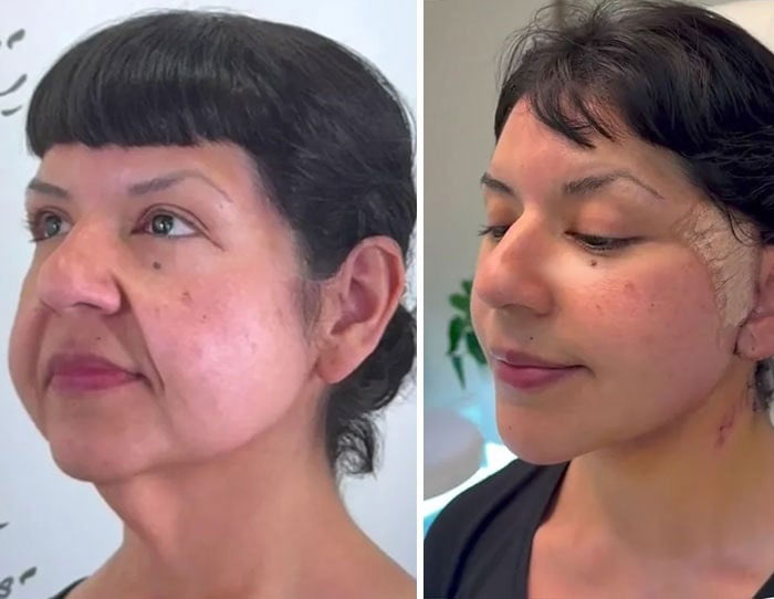Before-and-after photos showing a woman’s face with visible changes from a facelift procedure on each side.