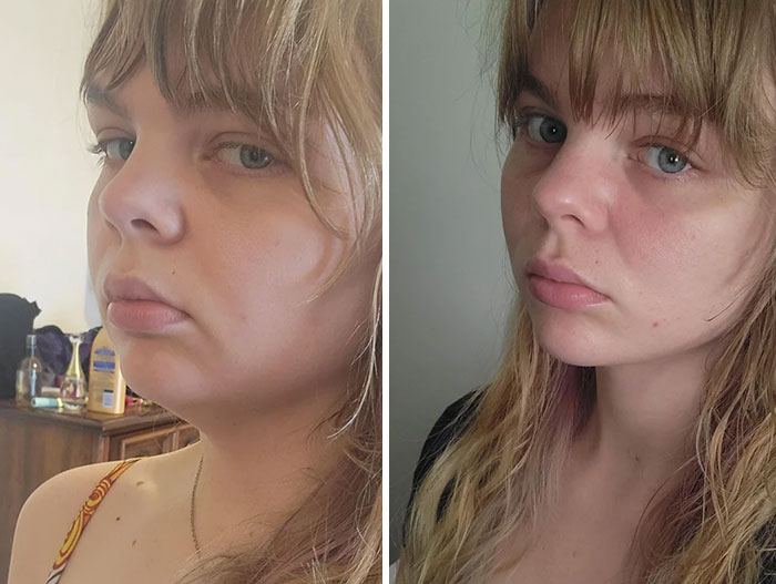 Before-and-after photos showing facial changes and improvement after facelift procedure on a young woman’s profile.