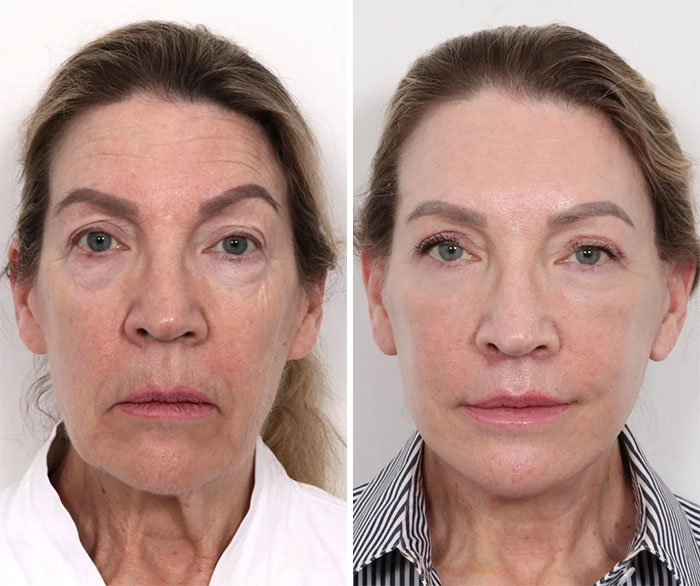 Before and after facelift photos showing significant facial rejuvenation and smoother skin on a middle-aged woman