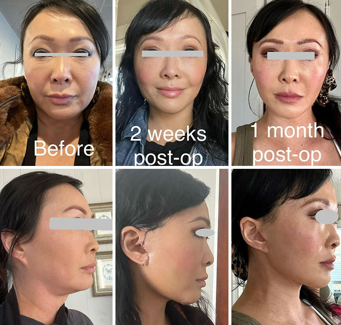 Woman’s facelift before and after photos showing front and side views at before, 2 weeks, and 1 month post-op stages.