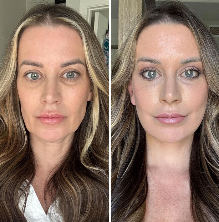 Side-by-side before and after photos of a woman showcasing facelift results with smoother skin and enhanced facial features