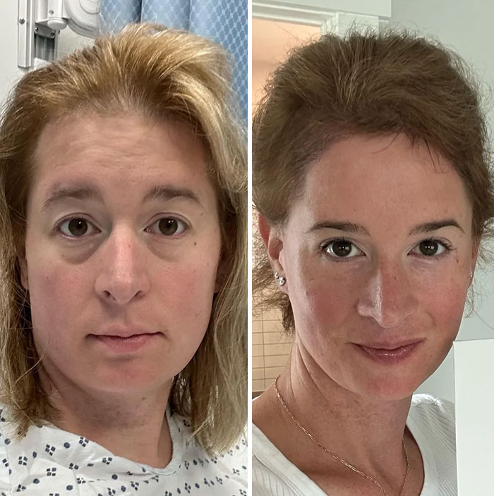 Before-and-after photos of a woman showing facial transformation and improvement after a facelift procedure.