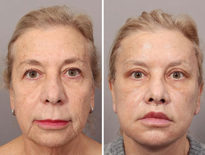 Before and after facelift photos showing noticeable improvements in skin tightness and facial contours on a mature woman.