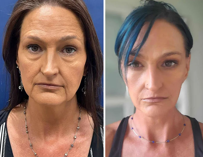 Before-and-after photos showing a woman’s facial transformation after a facelift procedure enhancing skin tightness and smoothness.