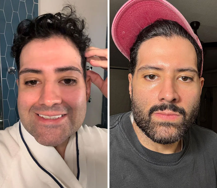 Before-and-after photos of a man showing facial changes and improvements after getting a facelift procedure.