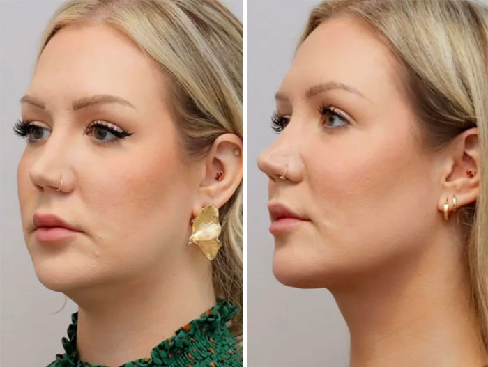 Before and after facelift photos showing a woman's facial transformation with smoother skin and defined jawline.