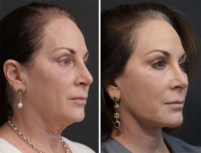 Before-and-after photos of a woman showing facial changes and improvements after a facelift procedure.