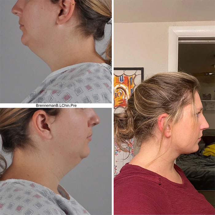 Before-and-after photos of a woman showcasing facial transformation results from a facelift procedure.
