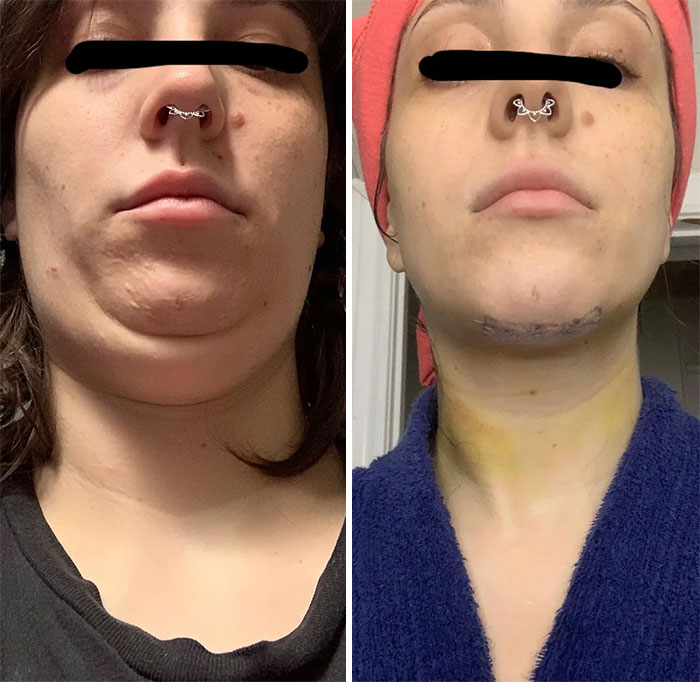 Before-and-after facelift photos showing significant reduction of double chin and improved jawline contour.