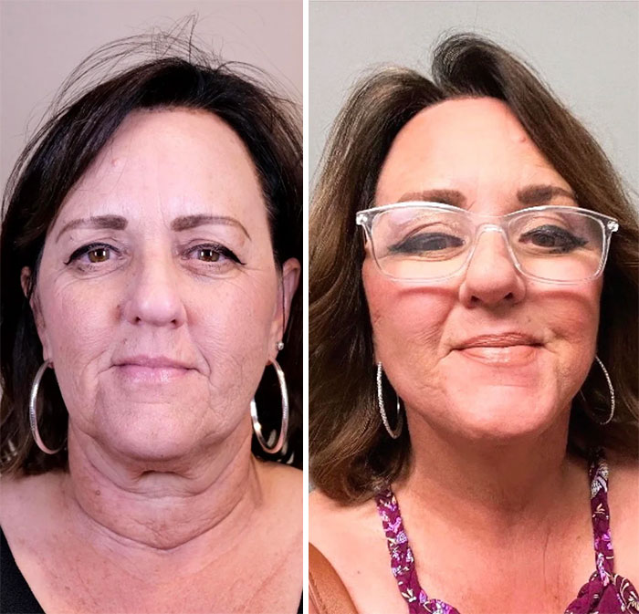 Before and after facelift photos showing a woman’s facial transformation with smoother skin and a youthful appearance.
