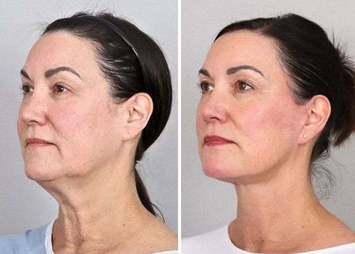 Side-by-side before and after photos of a woman showing facelift results with smoother, tighter skin and lifted facial features.
