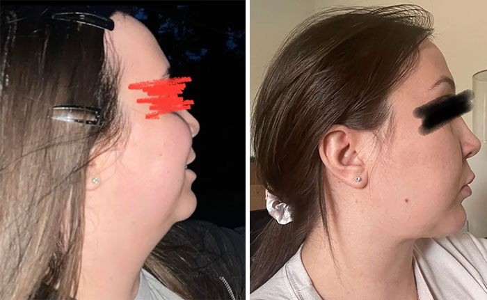 Side-by-side before and after photos of a woman showing facelift results with improved jawline and neck contour.