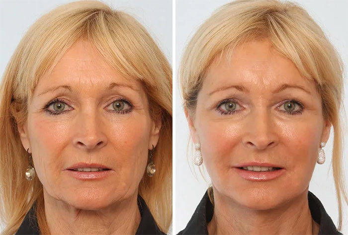 Before-and-after facelift photos showing a middle-aged woman with smoother, more youthful facial appearance.
