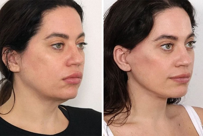 Side-by-side before and after facelift photos showing a woman with improved facial contour and skin tightness.