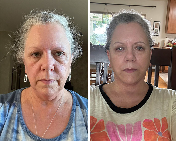 Before-and-after photos of a woman showing facial changes after a facelift procedure indoors.