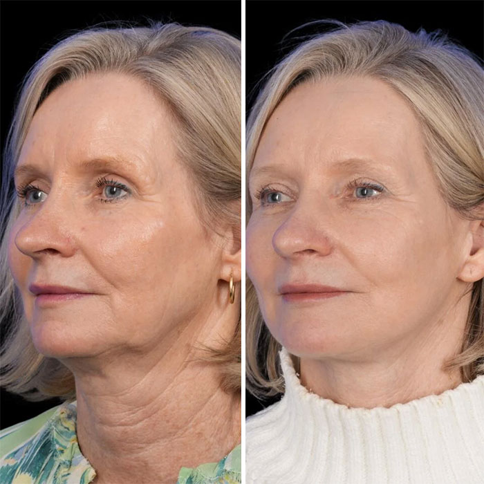 Side-by-side before and after photos of a woman showing facelift results with smoother skin and reduced wrinkles