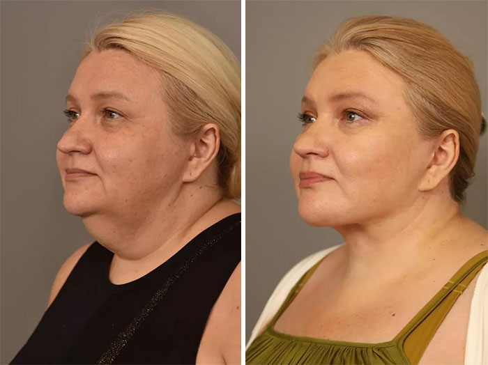 Before and after facelift photos showing a woman’s facial transformation with tighter skin and a more defined jawline.
