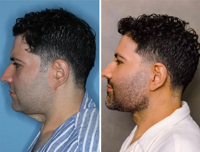 Side-by-side before and after photos of a man showing facelift results with improved jawline and neck contour.
