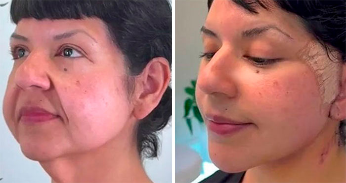 44 Times People Didn’t Regret Going Under The Knife, As It Looks Like They Time-Traveled