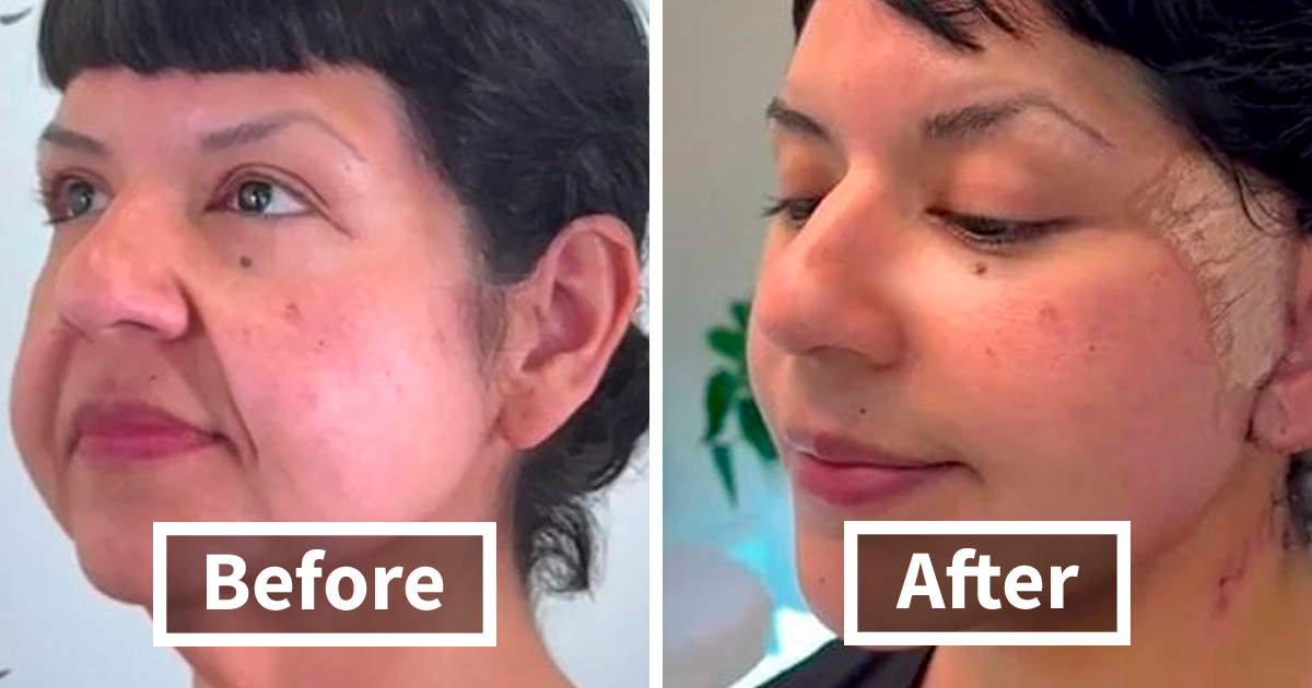 44 Insanely Good Facelift Results That Almost Reversed Time | Bored Panda