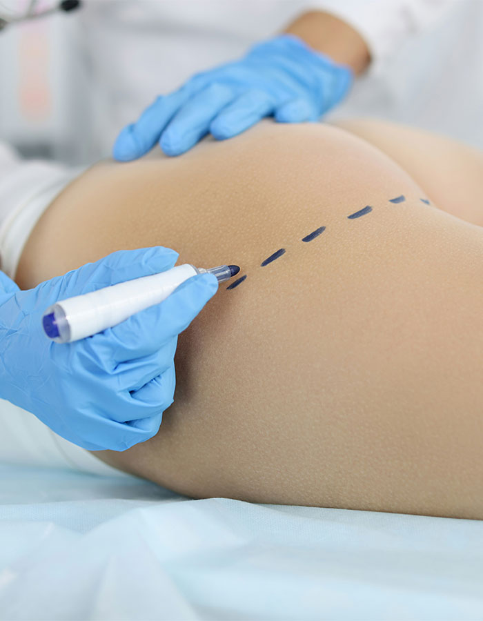 Close-up of a doctor marking a woman's butt for surgery, related to butt surgery and implants procedure. - 4