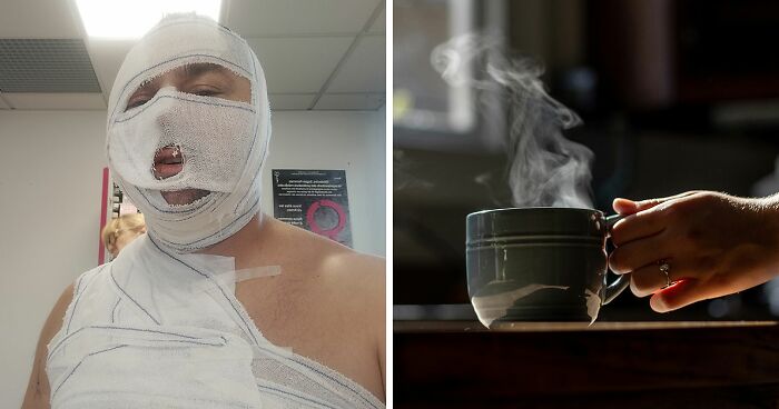 Man Wins Landmark Domestic Violence Case Against Ex-Girlfriend Who Scalded And Hospitalized Him