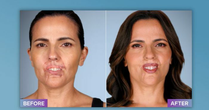 Plastic Surgeon Who Fixes “Botched” Operations Goes Viral After Netizens Discover Before-And-After Photos