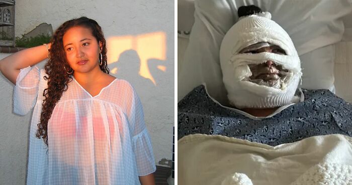 “Hope She Gets A Good Product Attorney”: Teen Suffers Disfiguring Injuries In S’mores-Making Accident