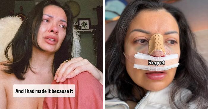 “Vanity Is Destroying So Many Lives”: Woman Claims Her $6,640 Nose Job ‘Ruined’ Her Face