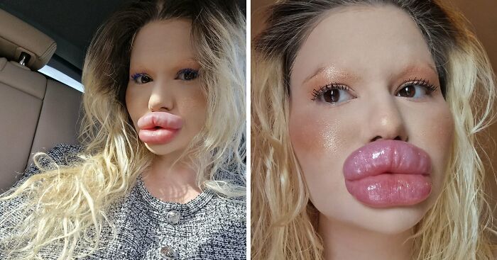 La mujer con los «labios más grandes del mundo» comparte cómo se veía antes de gastarse $26000 en cirugías extremas