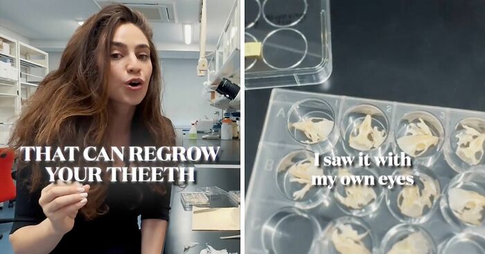 Scientists Make Tooth Regrowth Possible In Breakthrough That May Replace Dentures And Implants