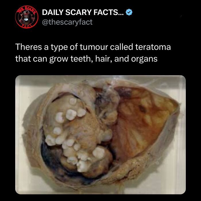 Tumor called teratoma containing teeth-like structures, hair, and organs, illustrating a scary medical fact in darkness.