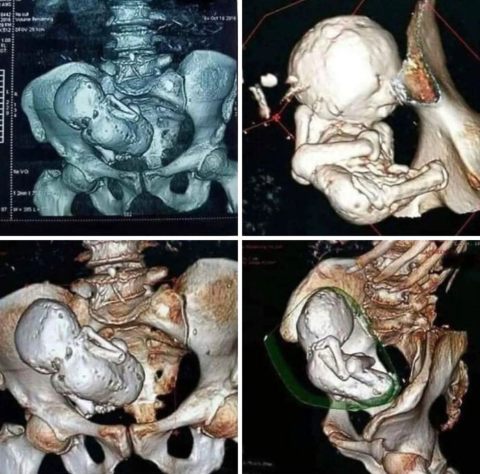 3D medical scans showing a rare fetal condition, shared by an online group of interesting facts and pics.