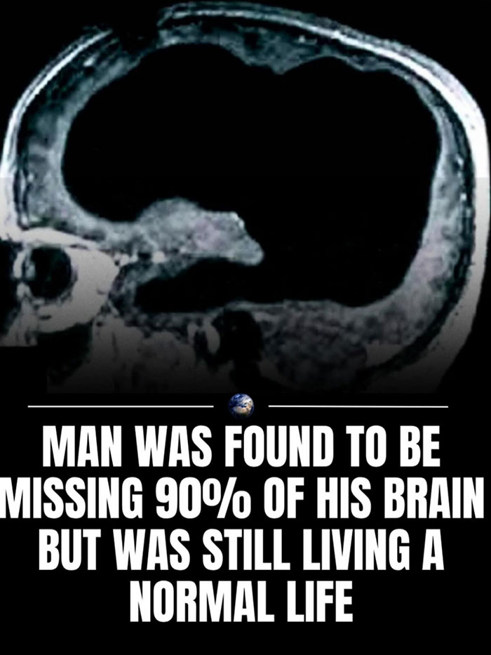 MRI scan showing a brain with 90 percent missing, highlighting a man living a normal life despite the condition. - 15