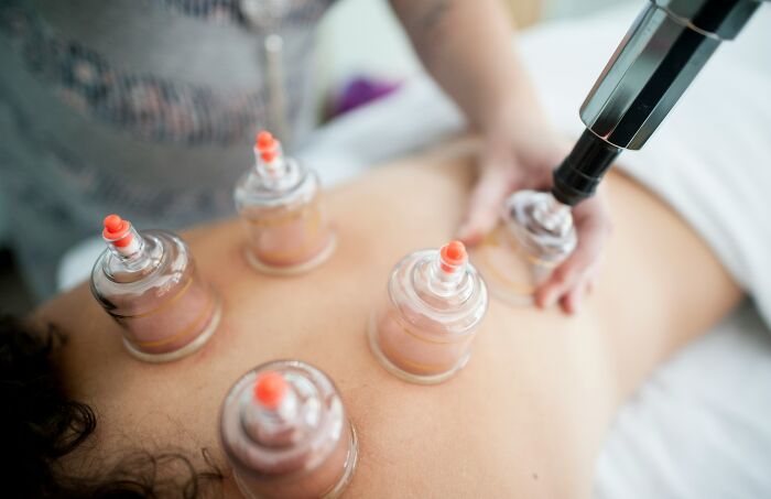 Person receiving cupping therapy on back, illustrating bizarre beliefs people still fall for despite science busting myths. - 30