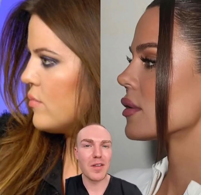 Side-by-side profile comparison of Khlo&eacute; Kardashian before and after cosmetic procedures with a man explaining results.