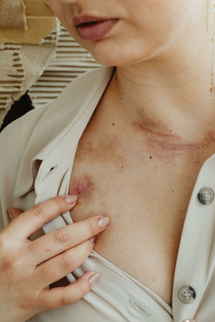 Close-up of a person revealing bruises on their chest and neck, highlighting a huge red flag in relationships. - 16