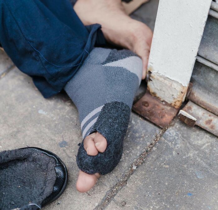 Person with a torn sock exposing toes sitting outdoors, illustrating wild and disgusting things people really did in public.