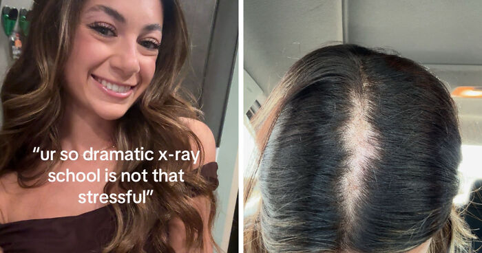 Side-by-side photos showing a woman smiling before and hair thinning after life happened stress effects.