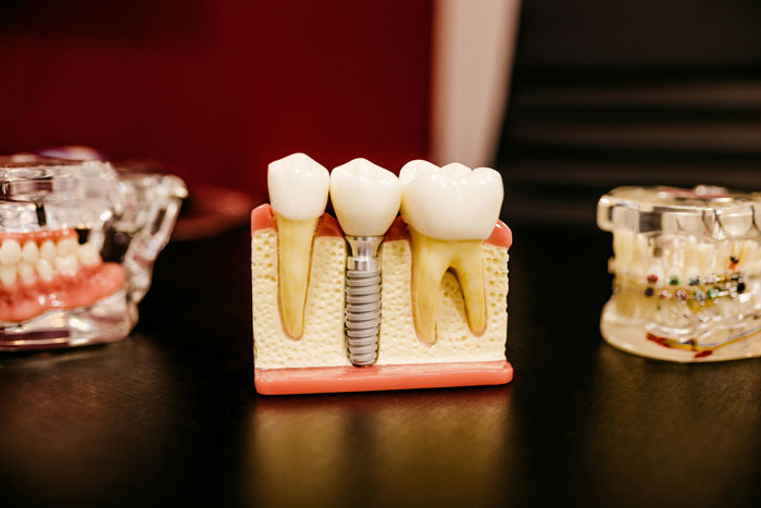 Model of natural teeth and dental implant showing tooth regrowth possibility in a breakthrough for denture replacement. Model of natural teeth and dental implant showing tooth regrowth possibility in a breakthrough for denture replacement.