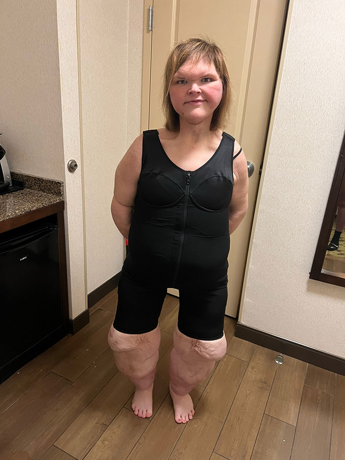 Tammy Slaton from 1000-Lb Sisters shows results of skin removal surgery wearing black compression garment indoors. - 4
