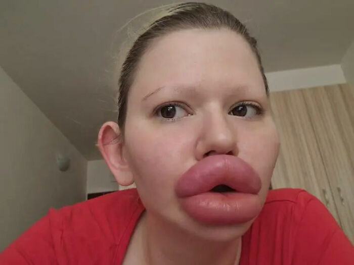 Woman with world&rsquo;s biggest lips wearing a red shirt, showing extreme lip enlargement after $26K surgeries.